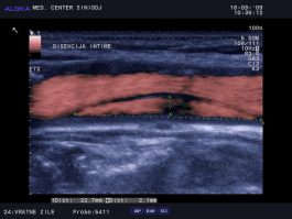 Ultrazvok vratnih žil - disekcija intime 2,3 x 0,2 cm, vzdolžno